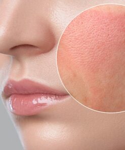 PIEL SENSIBLE Y/O ROSACEA